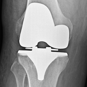 Post-Op Knee #1