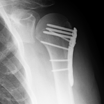 Post-Op Shoulder