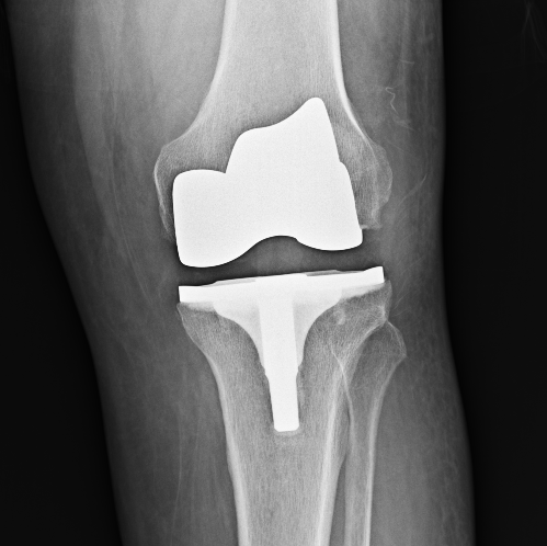 Post-Op Knee #2