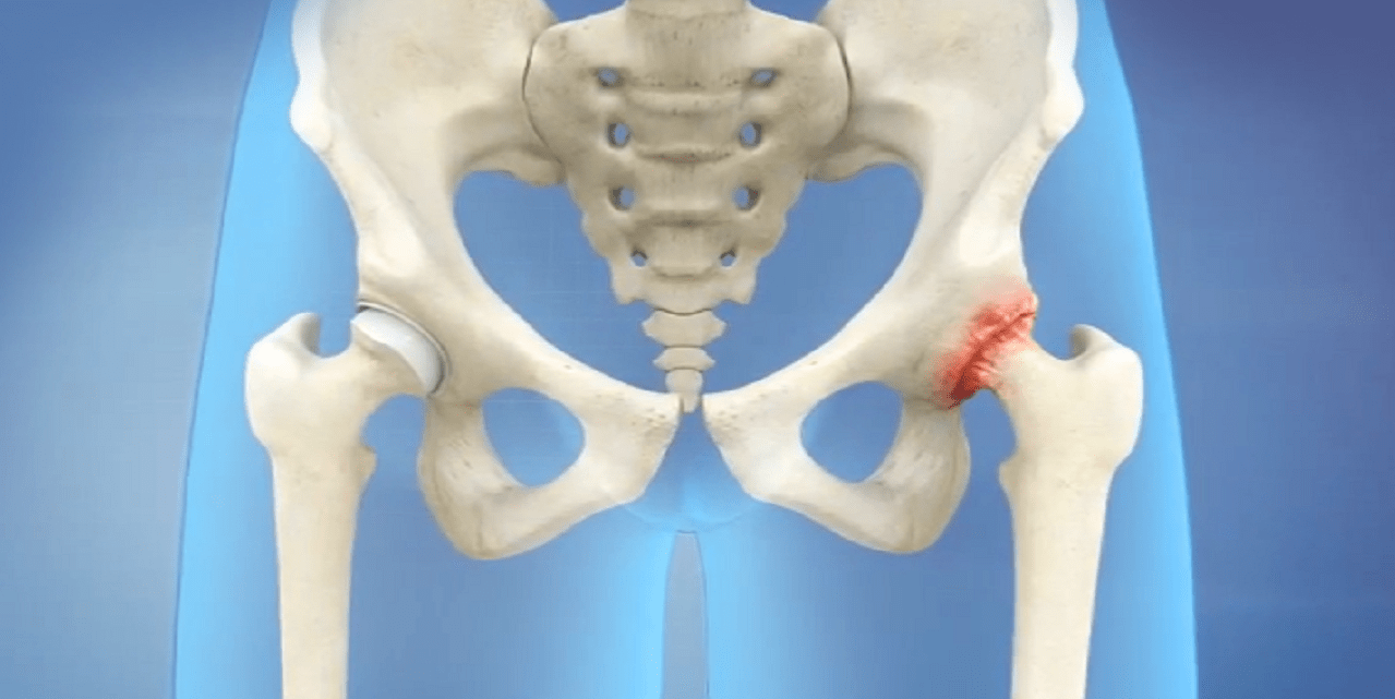 Northwest Hills Surgical Hospital - Hip Pain