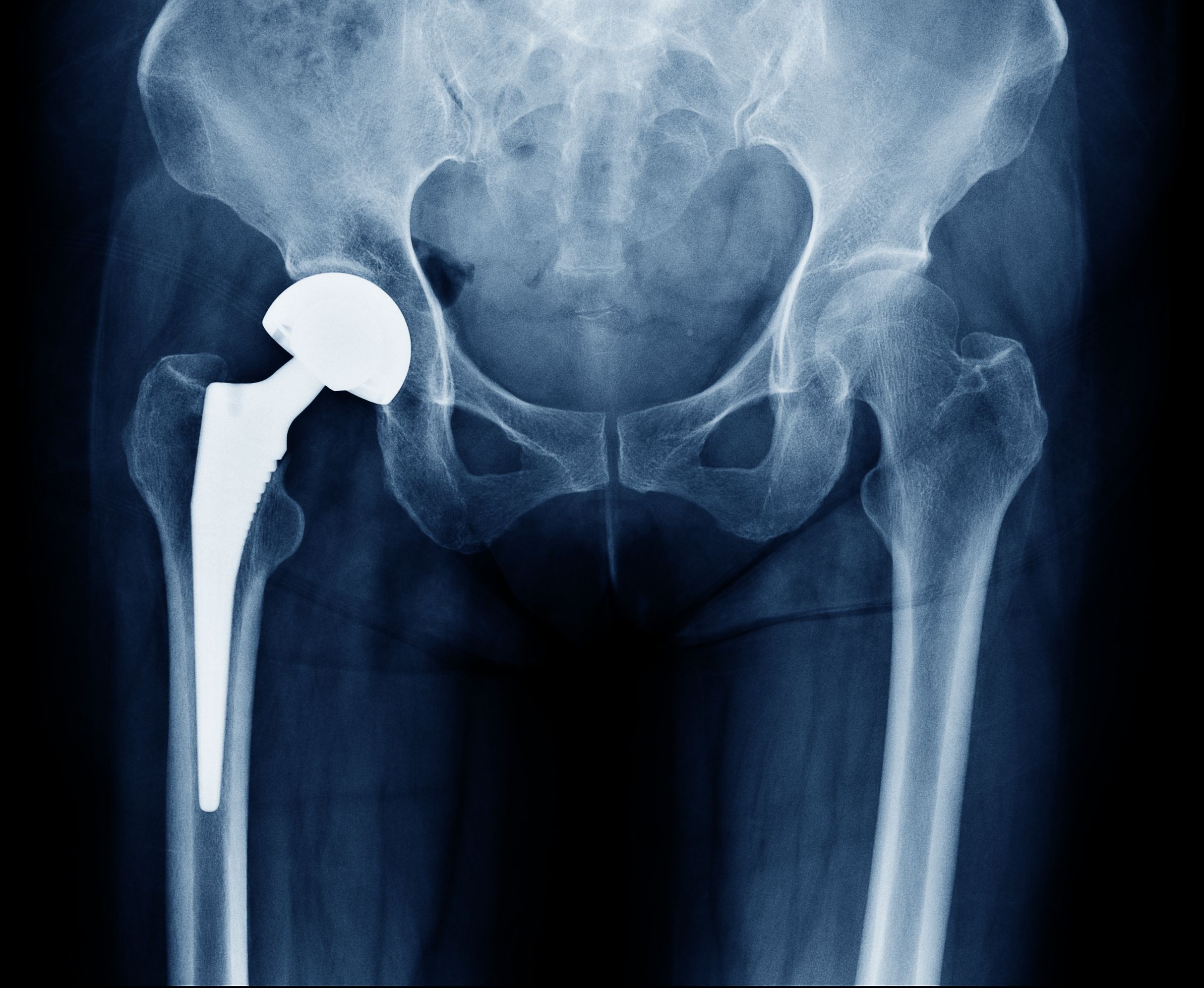 Post Operative Information for Hip Replacement Surgery Patients
