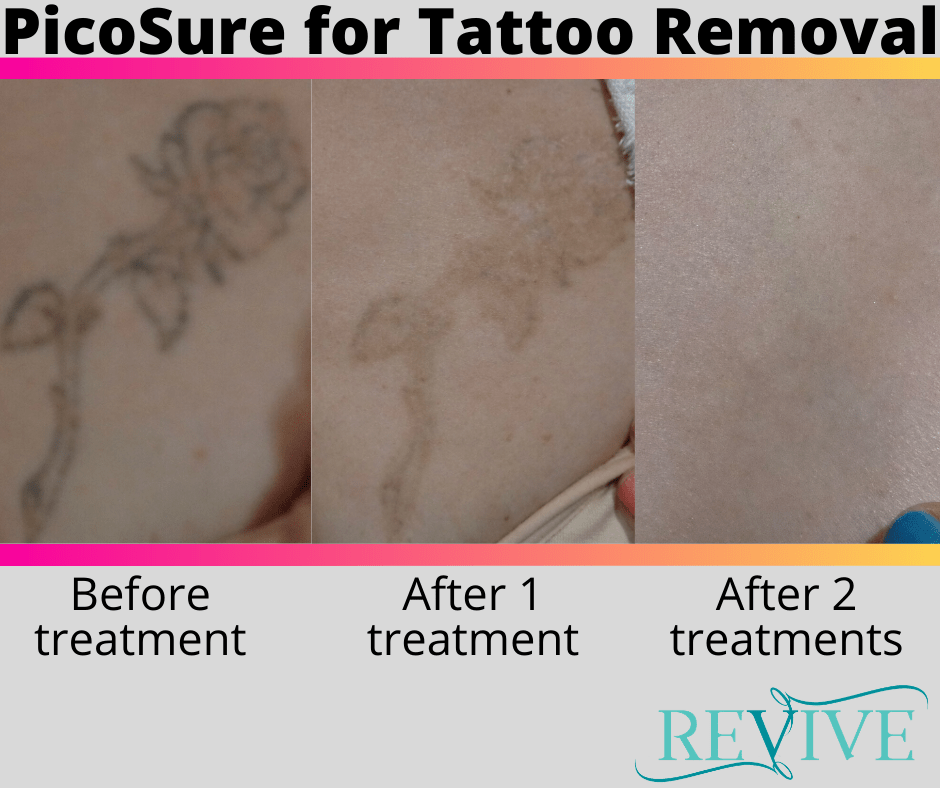 Picosure Tattoo Removal vs Picoway Tattoo Removal  Removery