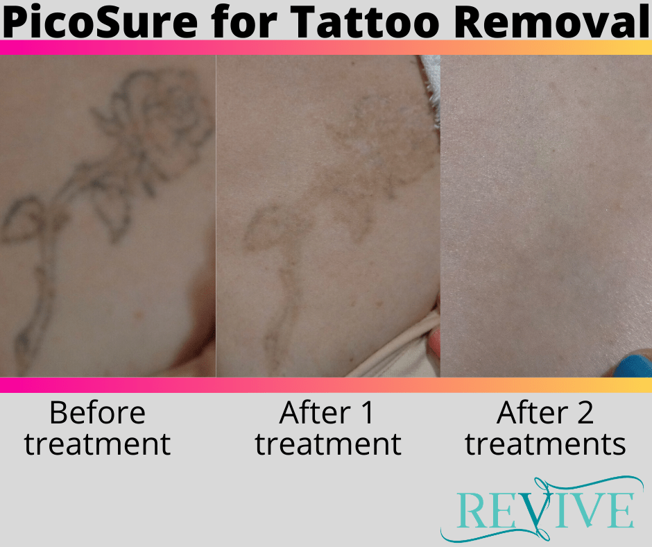 Picosure Tattoo Removal Before and After❤️Laser vs Non Laser