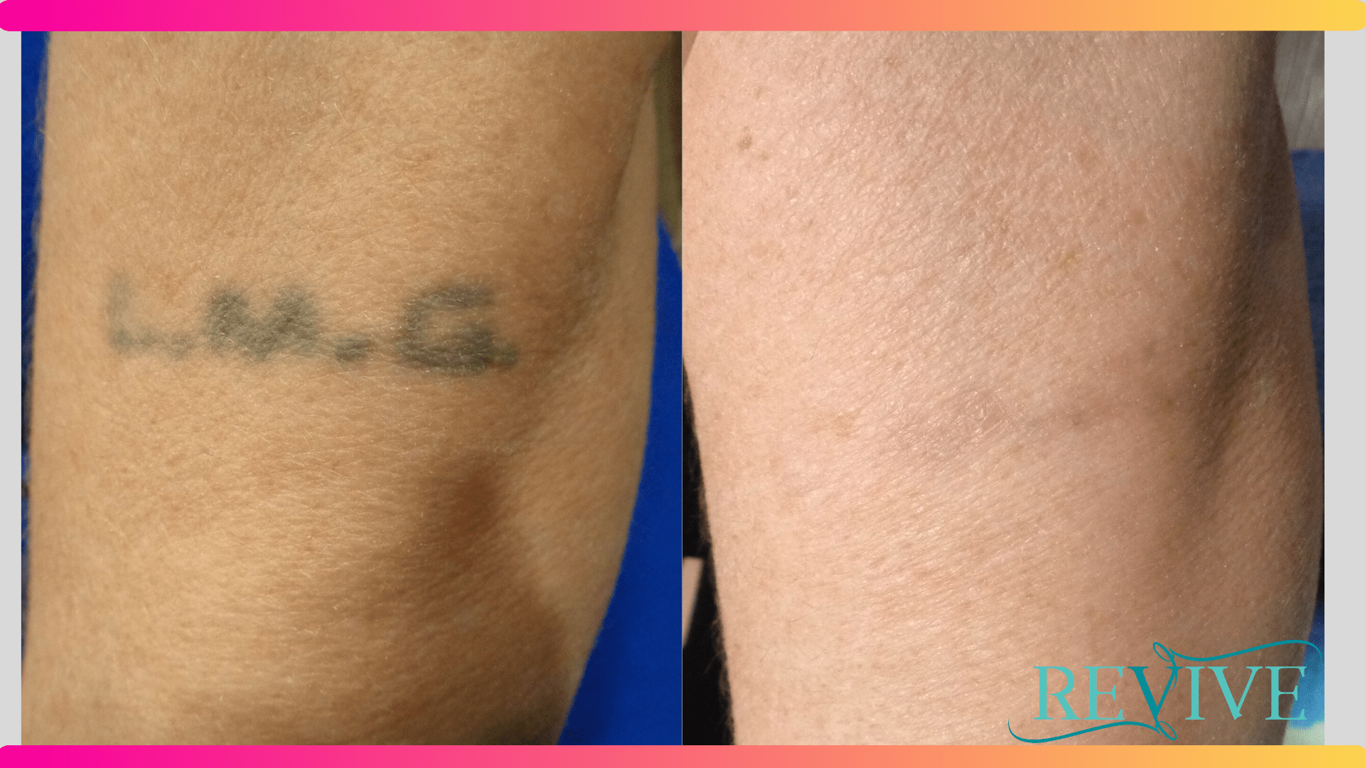 Flawless Before & After Facial Tattoo Removal | Removery