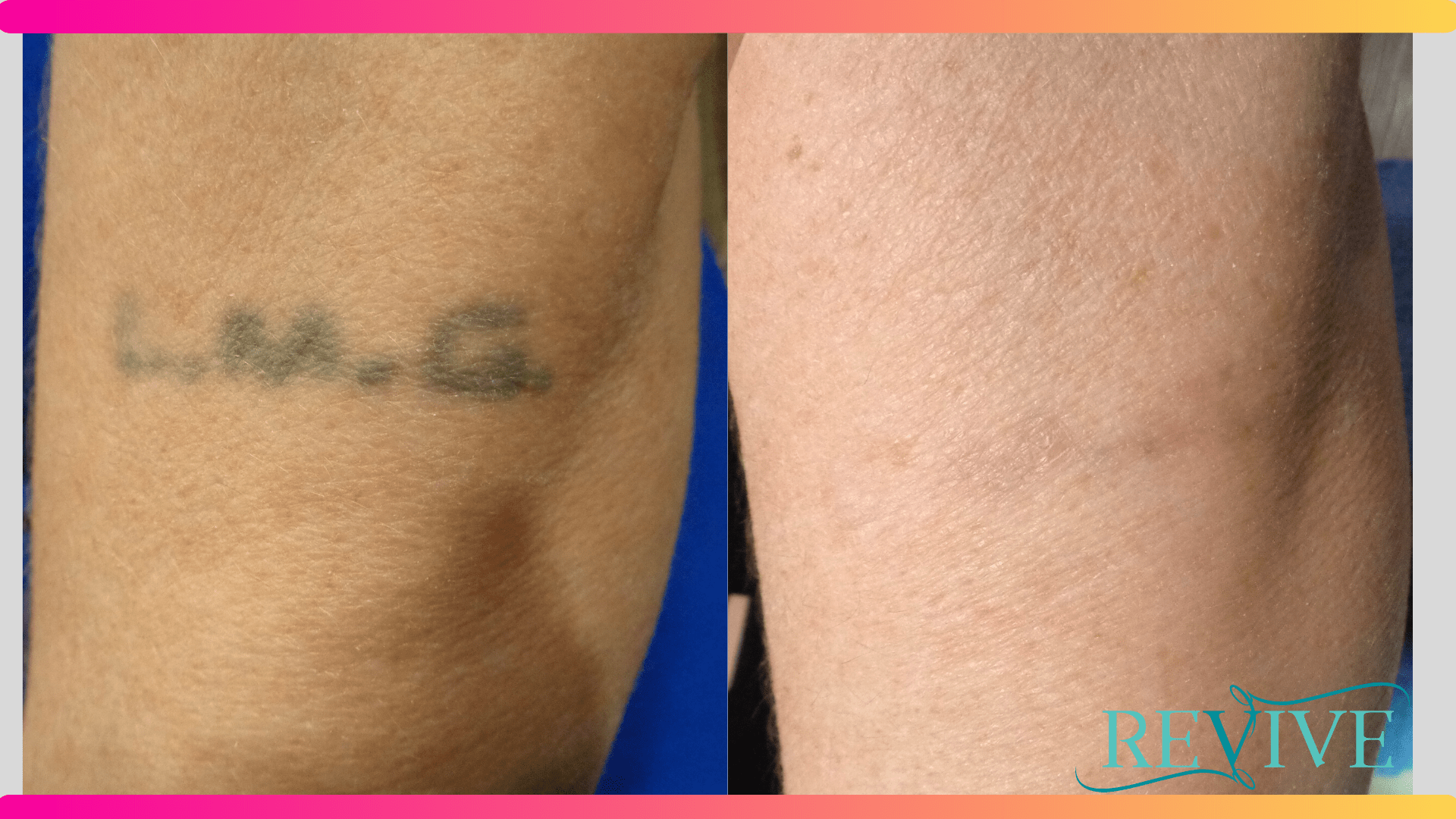 How does laser tattoo removal work? | Goodbye Tattoos