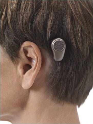 Bone-anchored hearing aid (Source: Wiki Commons)