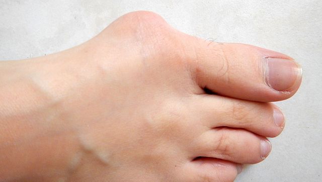 A large bunion protudes from the side of a big toe.