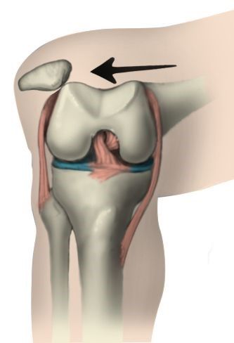 A diagram indicates how a kneecap can be dislocated.