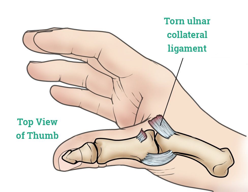 Top view of thumb showing torn ulnar collateral ligament 