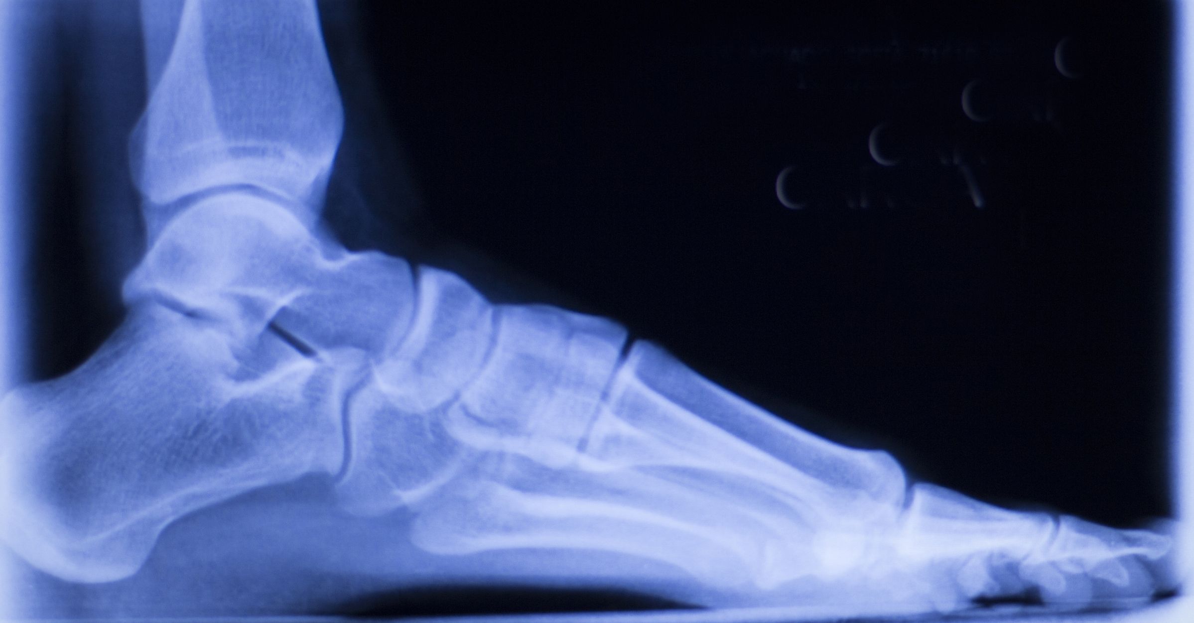 An x-ray depicts the bones in a patient's foot/ankle region.