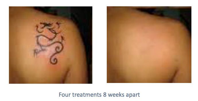 Vanish Laser Tattoo Removal  Skin Aesthetics  Dallas  Fort Worth