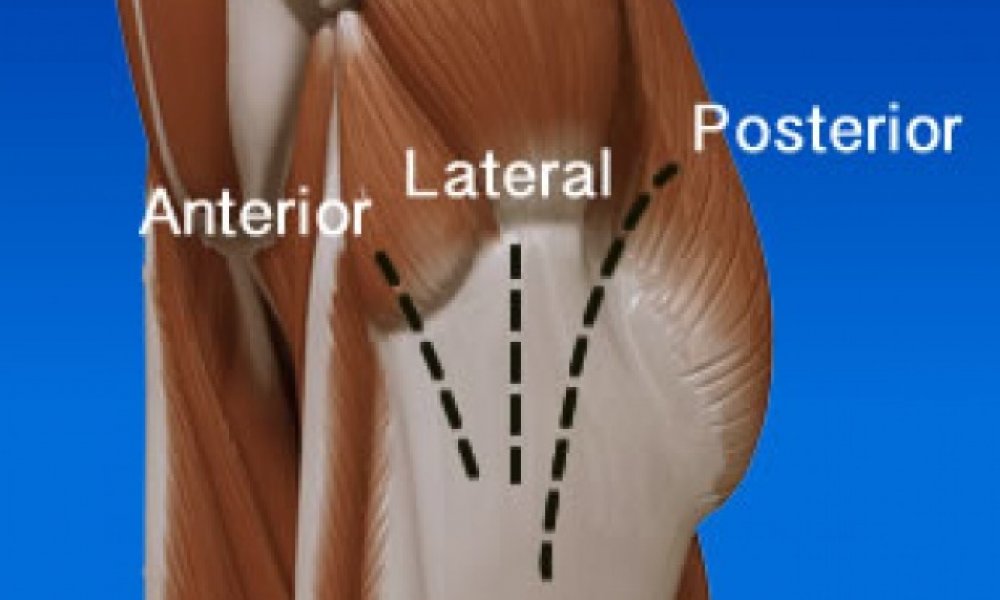 update-on-anterior-approach-hip-replacement-proliance-orthopedic