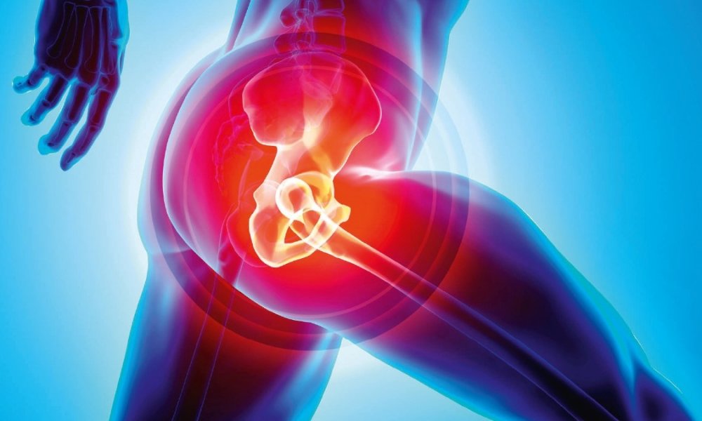 Hip Replacement | Proliance Orthopedic