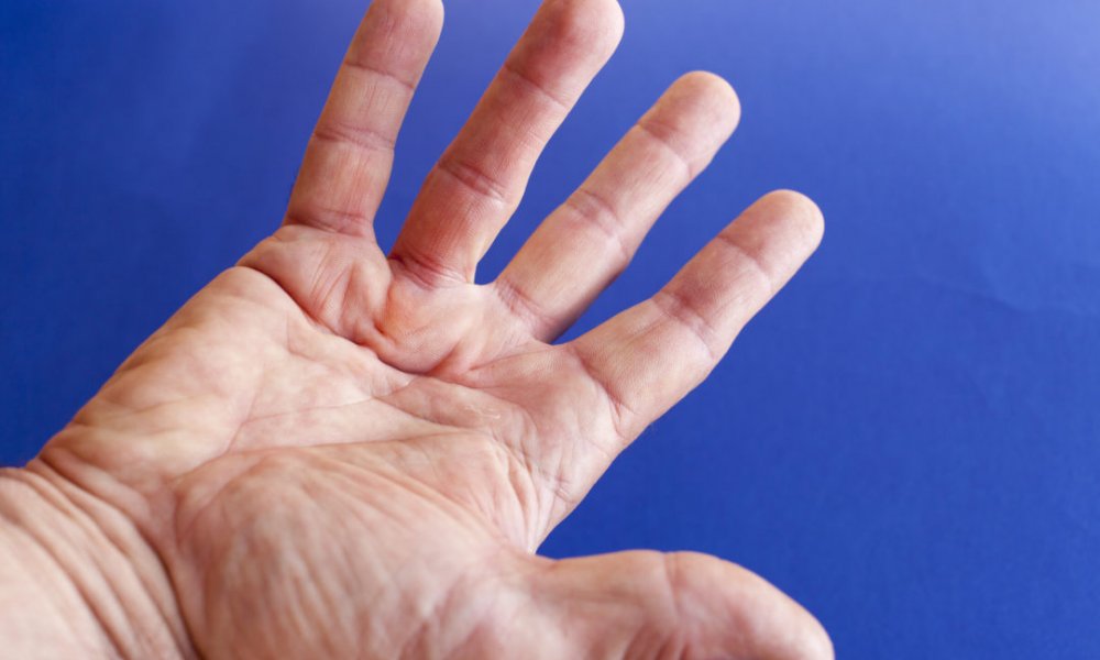 Dupuytren’s Contracture | Proliance Orthopedic