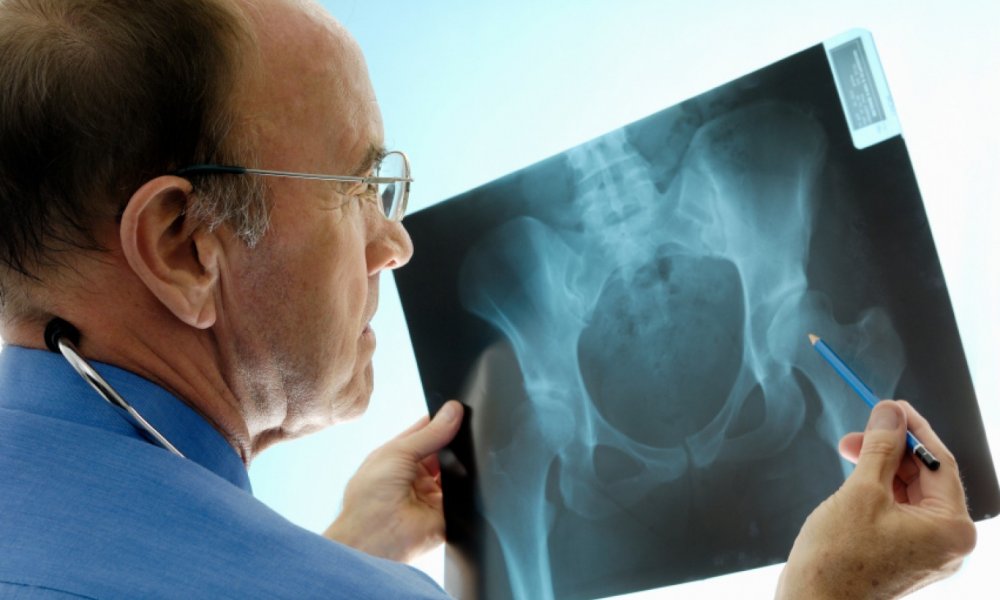 total-hip-replacement-surgery-the-process-proliance-orthopedic