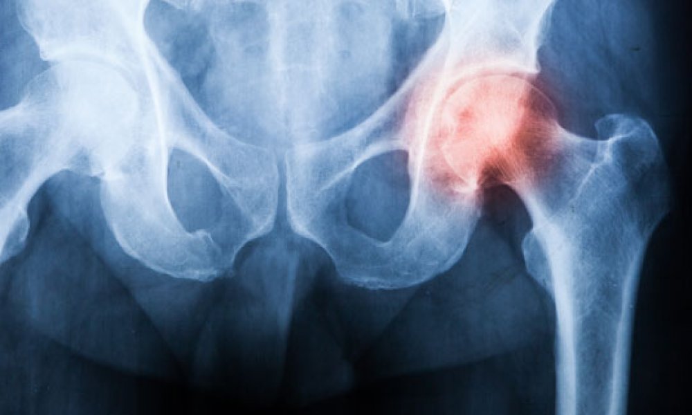 Hip Fractures More Likely for Women over 50 than Men