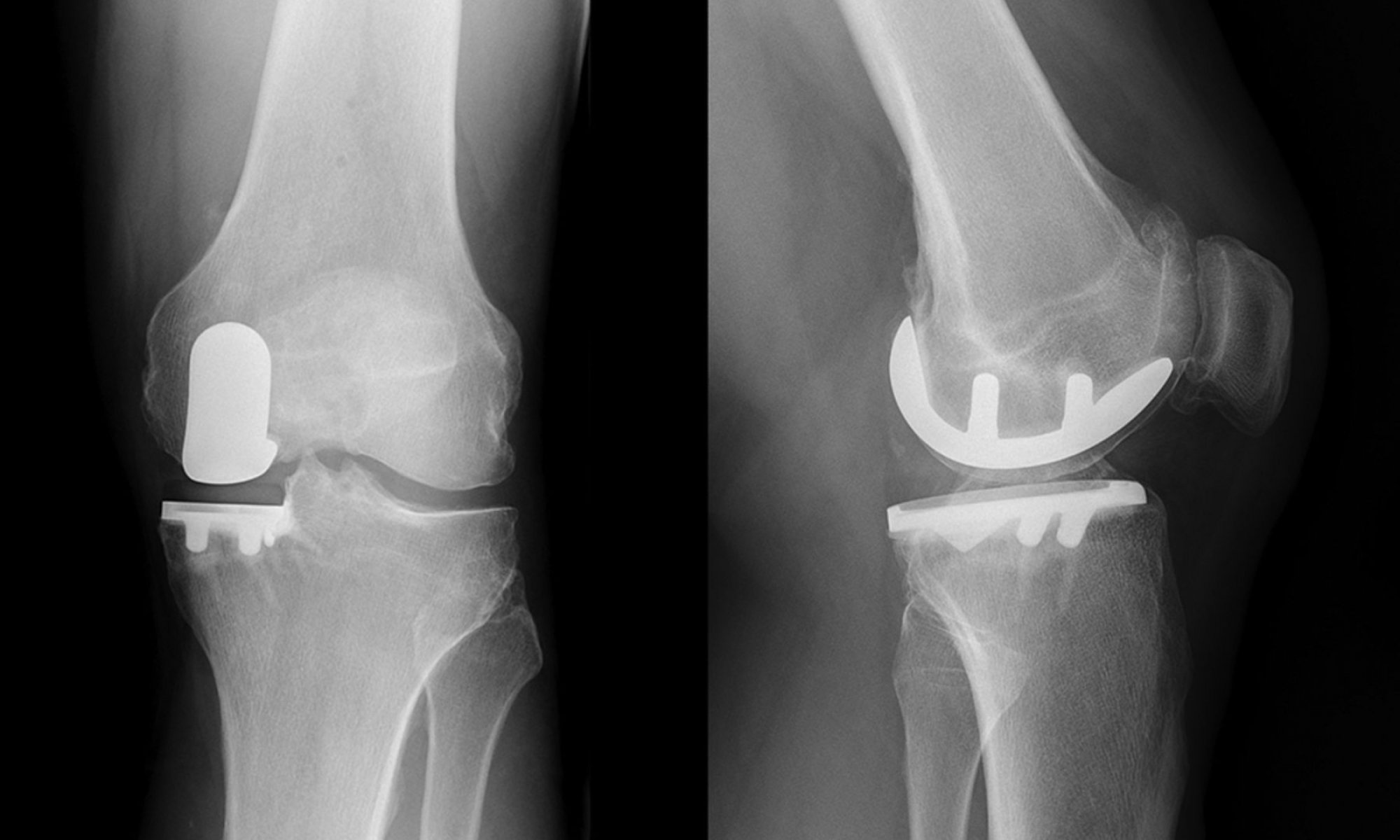 unicompartmental-or-partial-knee-replacement-proliance-orthopedic