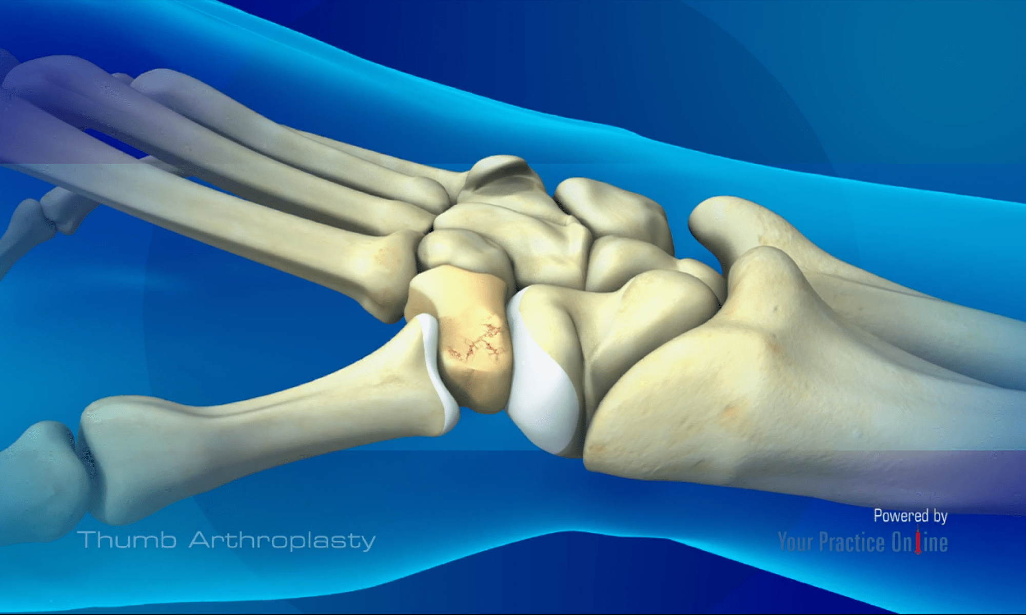 Thumb Arthroplasty Proliance Orthopedic 0960