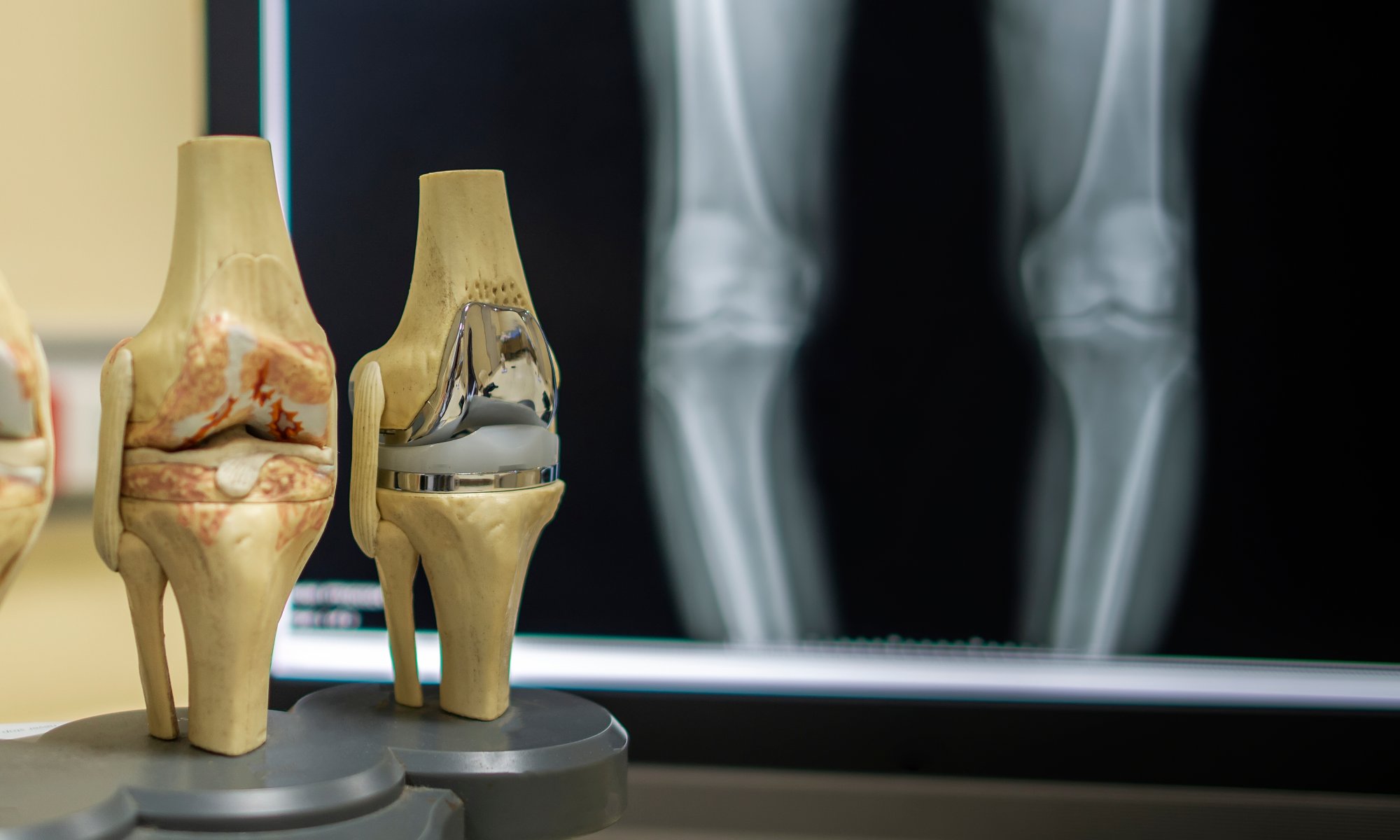 Dr. Barrett’s Blog What’s new in Knee Replacement 2019 Proliance