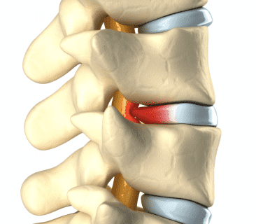 Image for How to Know if You Have a Spinal Disc Problem?
