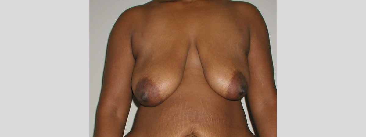Before This woman wanted a breast lift and didn’t want to be larger.  She had a SPAIR short scar breast lift with no implants.  Her “after” photos were taken about 6 months after surgery.