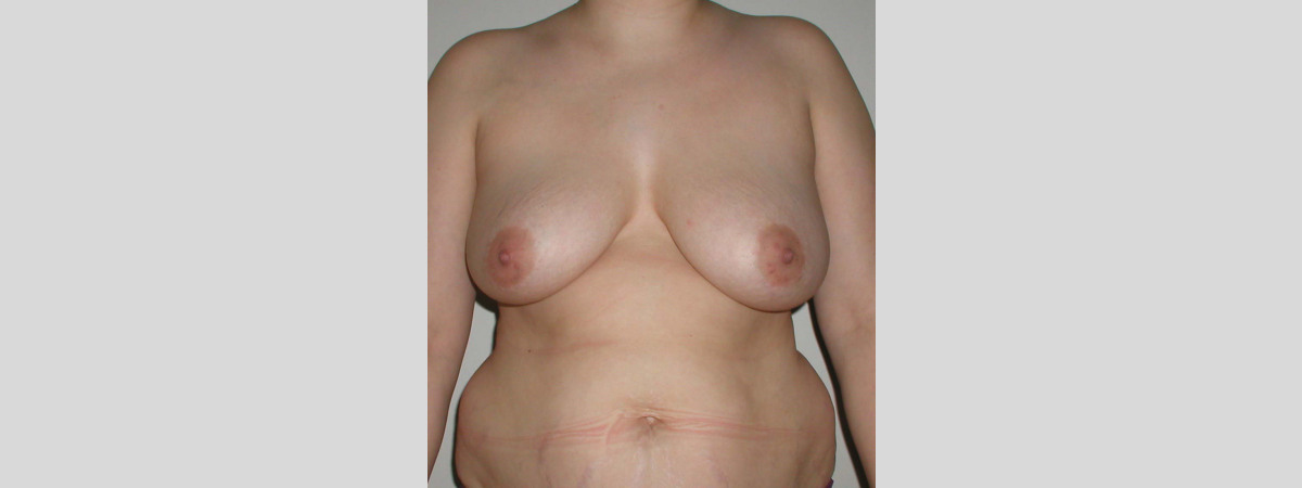 Before This woman had a SPAIR short scar breast lift.  Her “after” photos were taken about 1 year after surgery.