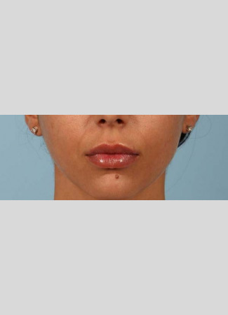After After 1 syringe of Juvederm Ultra Plus to lips