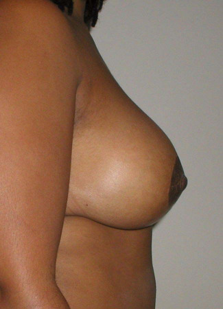 After This 35 year old female desired a breast reduction to alleviate back pain and shoulder pain.  Dr. Kavali performed a SPAIR short scar breast reduction technique, removing about 370 grams per breast.  Her “after” photos were taken about 6 months after surgery.
