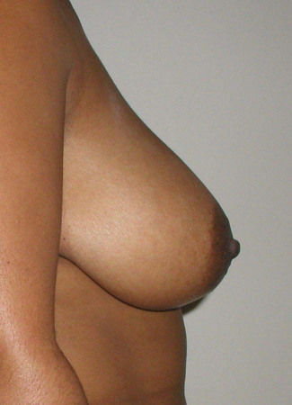 Before This 35 year old female desired a breast reduction to alleviate back pain and shoulder pain.  Dr. Kavali performed a SPAIR short scar breast reduction technique, removing about 370 grams per breast.  Her “after” photos were taken about 6 months after surgery.