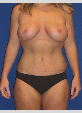 After This 27 year old woman lost 90 pounds after gastric bypass surgery.  She wanted to have a tighter tummy, fuller and rounder breasts, and smaller thighs.  Dr. Kavali performed an abdominoplasty with liposuction of the hips and waist, a breast augmentation with 339 cc gel implants, a breast lift (mastopexy), and liposuction of the inner and outer thighs.