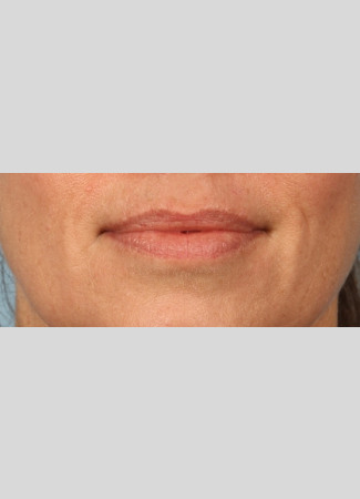 Before After 1 syringe of Juvederm Ultra Plus to lips