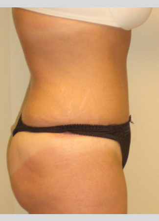 After This mom had an abdominoplasty (tummy tuck) to remove loose skin an