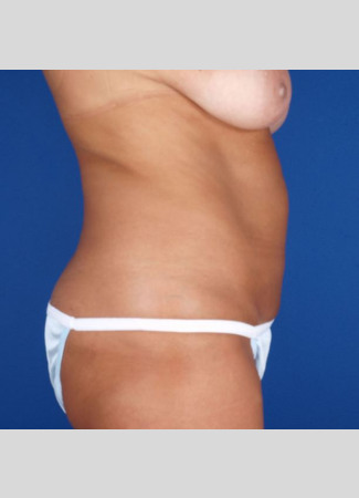 After This 49 year old female had 8 hours of CoolSculpting to achieve her contouring goals.  She treated her abdomen, waist, and lower back.