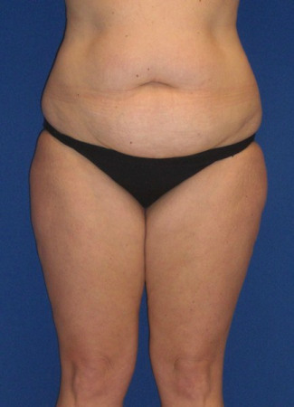 Before This woman had an abdominoplasty (tummy  tuck) at the same time as liposuction of her hips, waist, and inner and outer thighs.