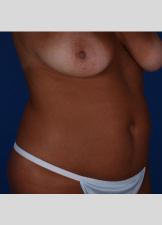 Before This 49 year old female had 8 hours of CoolSculpting to achieve her contouring goals.  She treated her abdomen, waist, and lower back.