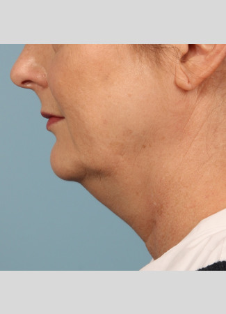 Before Results after 3 Kybella Treatments