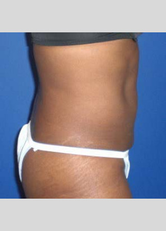 After This 46 year old female had 2 hours of CoolSculpting to contour her upper and lower central abdomen.