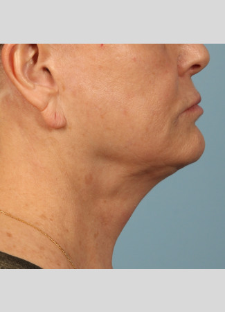 After Results after 2 Kybella treatments