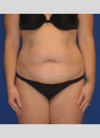 Before This Georgia mom had an abdominoplasty (tummy tuck) to remove loose skin and tighten her tummy muscles. She also had liposuction of her waist at the same time.  She is shown about 1 year after surgery.