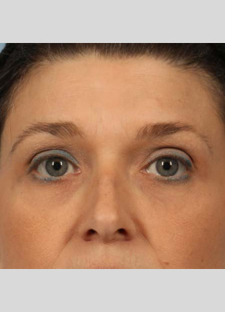 Before An Ulthera browlift: the power of ultrasound generates heat deep in the tissues to create a lifting effect and stimulate collagen for a lasting result.