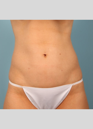 After Power-assisted liposuction of the abdomen and lower back (love handles) in the office under local anesthesia