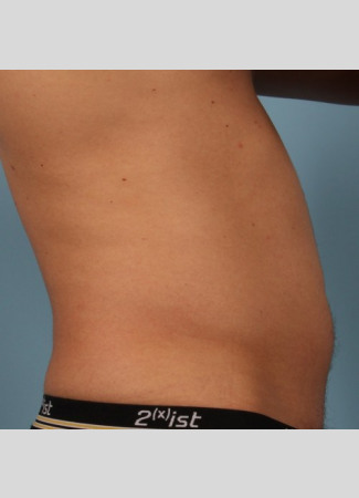 Before This Atlanta man chose CoolSculpting to contour his abs and waist. He is shown about 2 months after his treatment.