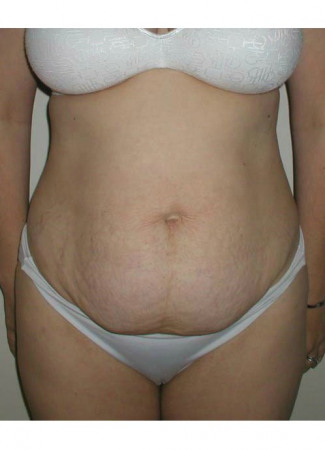Before This Atlanta mom had an abdominoplasty (tummy tuck)  to remove loose skin and tighten her tummy muscles. She also had liposuction of her waist at the same time.  She is shown about 1 year after surgery.