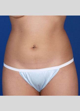 After This 27 year old female had CoolSculpting to contour her abdomen, waist, and lower back.  She had a total of 6 treatment hours.  Her “after” photos were taken about 60 days after her last treatment.