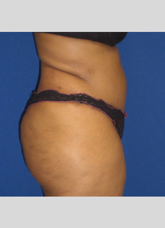 After This Georgia mom had an abdominoplasty (tummy tuck)  to remove loose skin and tighten her tummy muscles. She also had liposuction of her waist at the same time.  She is shown about 6 years after surgery.