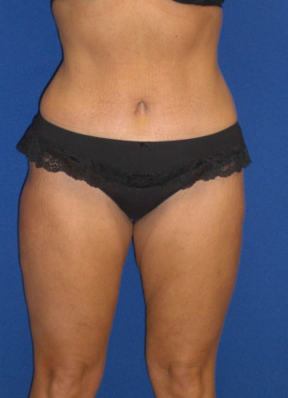 After This woman had an abdominoplasty (tummy  tuck) at the same time as liposuction of her hips, waist, and inner and outer thighs.