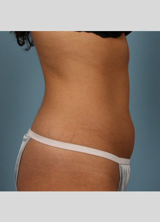 After This 23 year old Atlanta female chose CoolSculpting to contour her abdomen.  She first had 3 treatment cycles on her lower abdomen, then came back for another 2 treatment cycles on her upper abdomen. Her final photos were taken about 2 months after her last treatment.