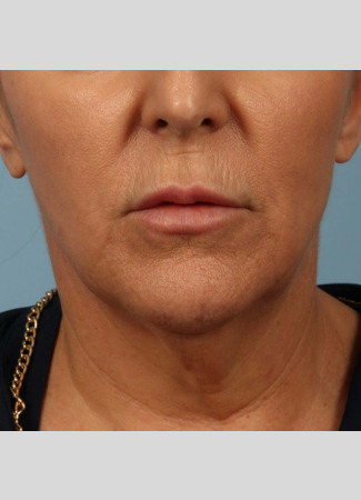Before This 58 year old Atlanta woman chose Kybella with Dr. Kavali to reduce the fullness in her neck.  Her results are shown 6 months after 3 Kybella treatments. She is thrilled with her results!