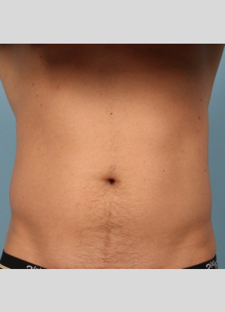 Before This Atlanta man chose CoolSculpting to contour his abs and waist. He is shown about 2 months after his treatment.