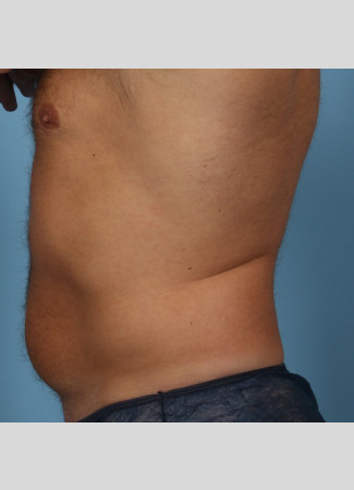 After This Atlanta male chose CoolSculpting to contour his abdomen and waist. He is shown before and about 2 months after his treatment. He completed 3 treatment cycles